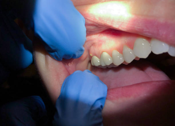 Best Emergency Dental Care for Abscessed Tooth in Itasca, IL
