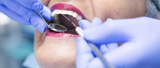 Best Emergency Dental Extractions in Itasca, IL